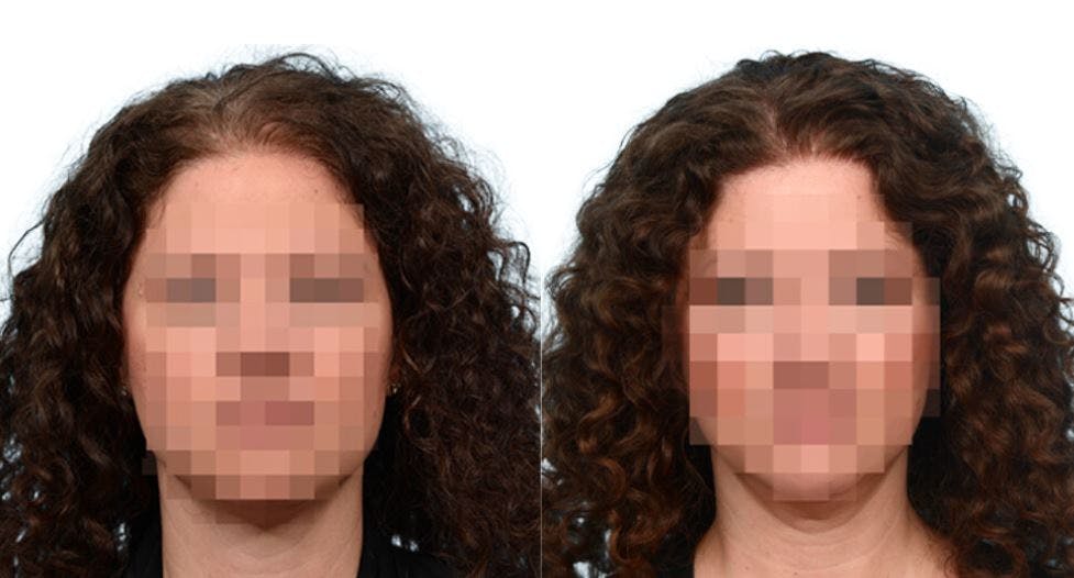 Platelet-Rich-Plasma Before & After Gallery - Patient 403024 - Image 1