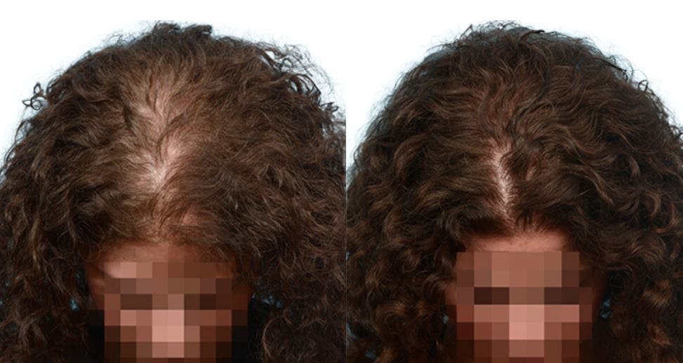 Platelet-Rich-Plasma Before & After Gallery - Patient 403024 - Image 2