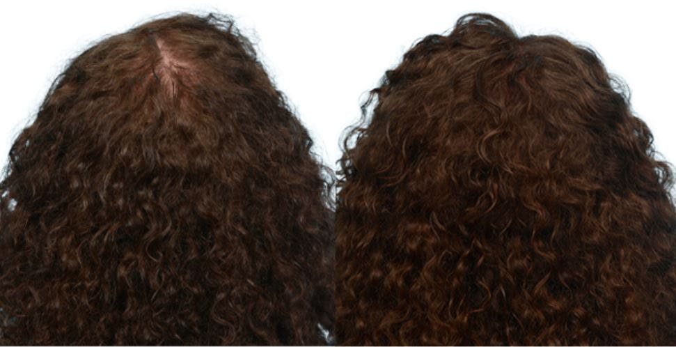 Platelet-Rich-Plasma Before & After Gallery - Patient 403024 - Image 3