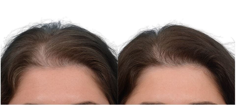Platelet-Rich-Plasma Before & After Gallery - Patient 146361 - Image 1