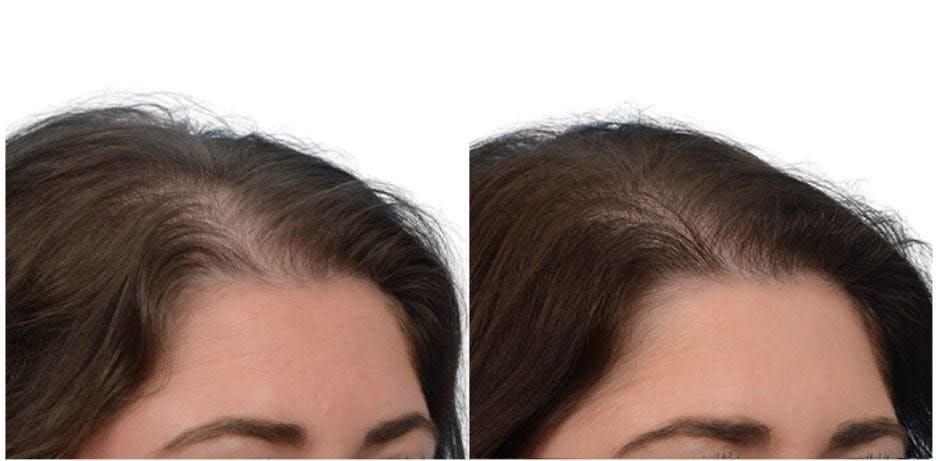 Platelet-Rich-Plasma Before & After Gallery - Patient 146361 - Image 2