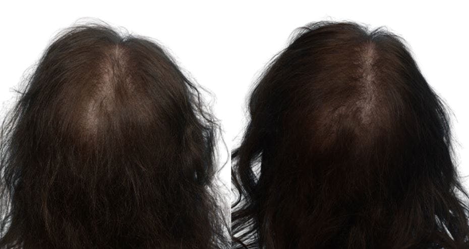 Platelet-Rich-Plasma Before & After Gallery - Patient 146361 - Image 3