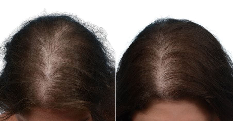 Platelet-Rich-Plasma Before & After Gallery - Patient 146361 - Image 4