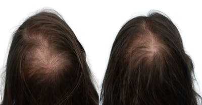 Platelet-Rich-Plasma Before & After Gallery - Patient 150780 - Image 1