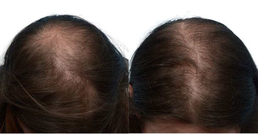 Platelet-Rich-Plasma Before & After Gallery - Patient 150780 - Image 2
