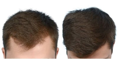 Platelet-Rich-Plasma Before & After Gallery - Patient 314680 - Image 1