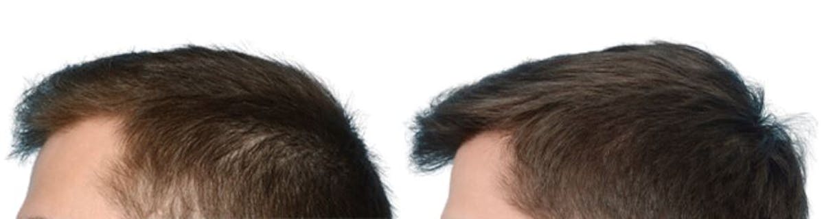 Platelet-Rich-Plasma Before & After Gallery - Patient 314680 - Image 2