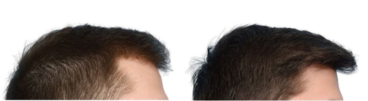 Platelet-Rich-Plasma Before & After Gallery - Patient 314680 - Image 3