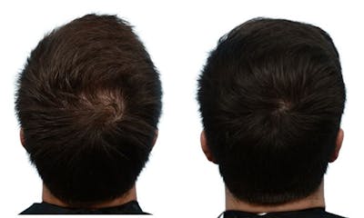 Platelet-Rich-Plasma Before & After Gallery - Patient 360025 - Image 1
