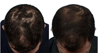 Platelet-Rich-Plasma Before & After Gallery - Patient 267152 - Image 1