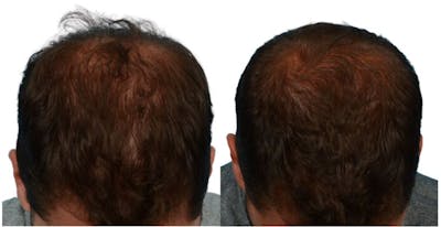 Platelet-Rich-Plasma Before & After Gallery - Patient 996866 - Image 1