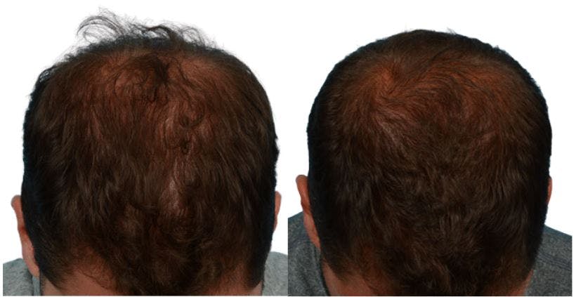 Platelet-Rich-Plasma Before & After Gallery - Patient 996866 - Image 1