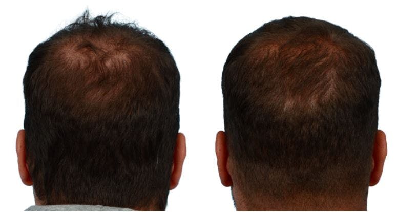 Platelet-Rich-Plasma Before & After Gallery - Patient 996866 - Image 2