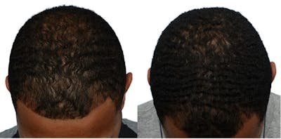 Platelet-Rich-Plasma Before & After Gallery - Patient 475229 - Image 1