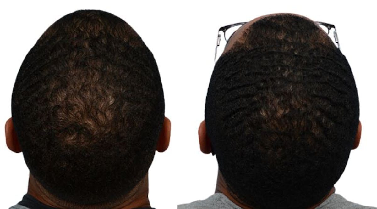 Platelet-Rich-Plasma Before & After Gallery - Patient 475229 - Image 2