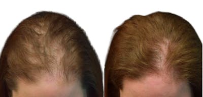 Platelet-Rich-Plasma Before & After Gallery - Patient 757297 - Image 1