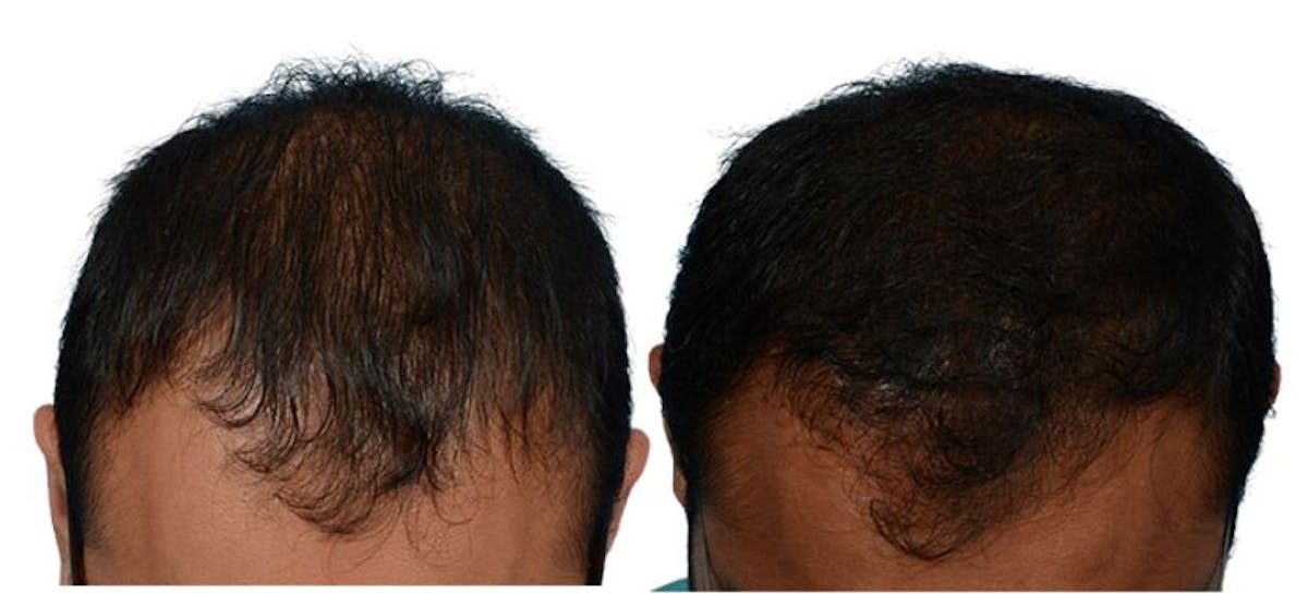Platelet-Rich-Plasma Before & After Gallery - Patient 704451 - Image 1