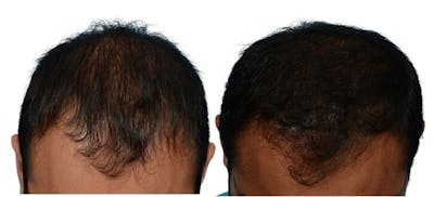 Platelet-Rich-Plasma Before & After Gallery - Patient 704451 - Image 1