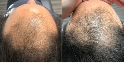 Platelet-Rich-Plasma Before & After Gallery - Patient 328079 - Image 1