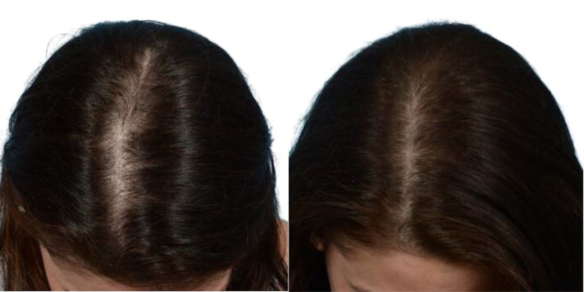 Platelet-Rich-Plasma Before & After Gallery - Patient 753038 - Image 1