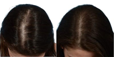 Platelet-Rich-Plasma Before & After Gallery - Patient 753038 - Image 1