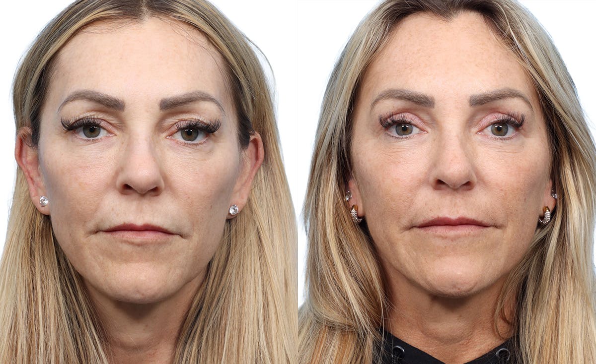 Blepharoplasty (Eyelid Surgery) Before & After Gallery - Patient 411628 - Image 1