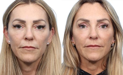 Blepharoplasty (Eyelid Surgery) Before & After Gallery - Patient 411628 - Image 1