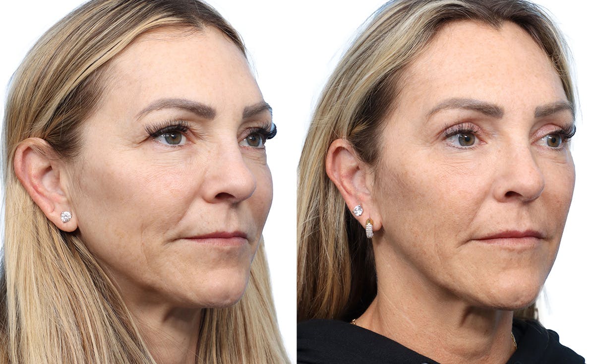 Blepharoplasty (Eyelid Surgery) Before & After Gallery - Patient 411628 - Image 3