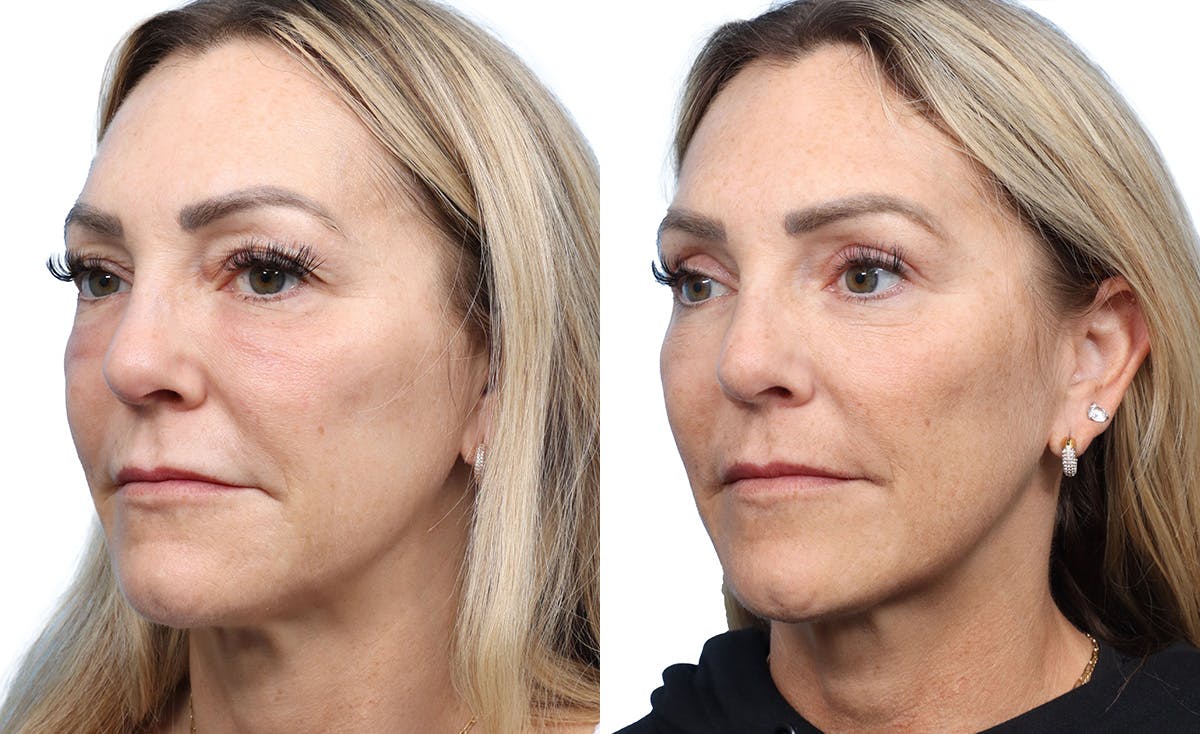 Blepharoplasty (Eyelid Surgery) Before & After Gallery - Patient 411628 - Image 2