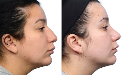 Rhinoplasty Before & After Gallery - Patient 901334 - Image 1