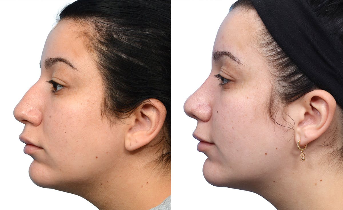 Rhinoplasty Before & After Gallery - Patient 901334 - Image 2