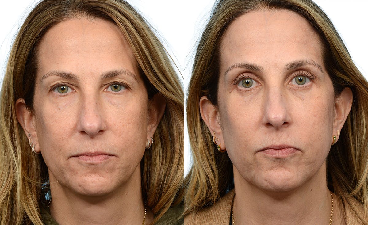 CO2 Laser Before & After Gallery - Patient 164706 - Image 3