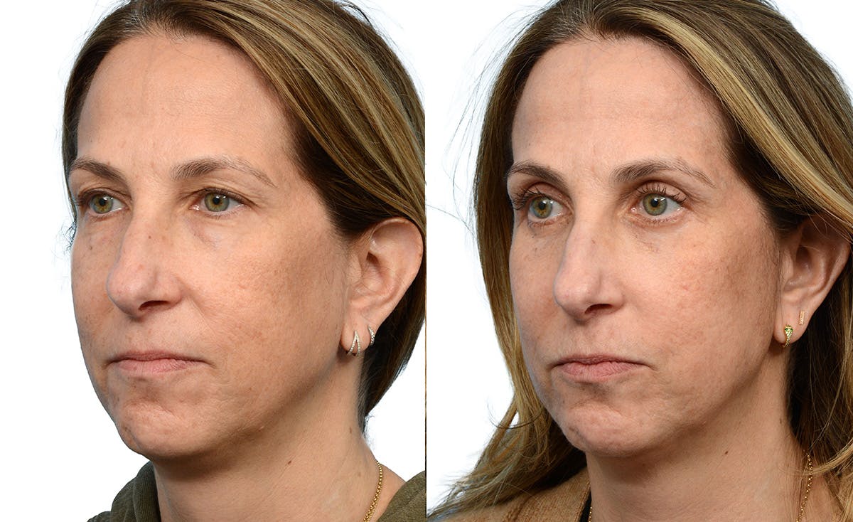 CO2 Laser Before & After Gallery - Patient 164706 - Image 4