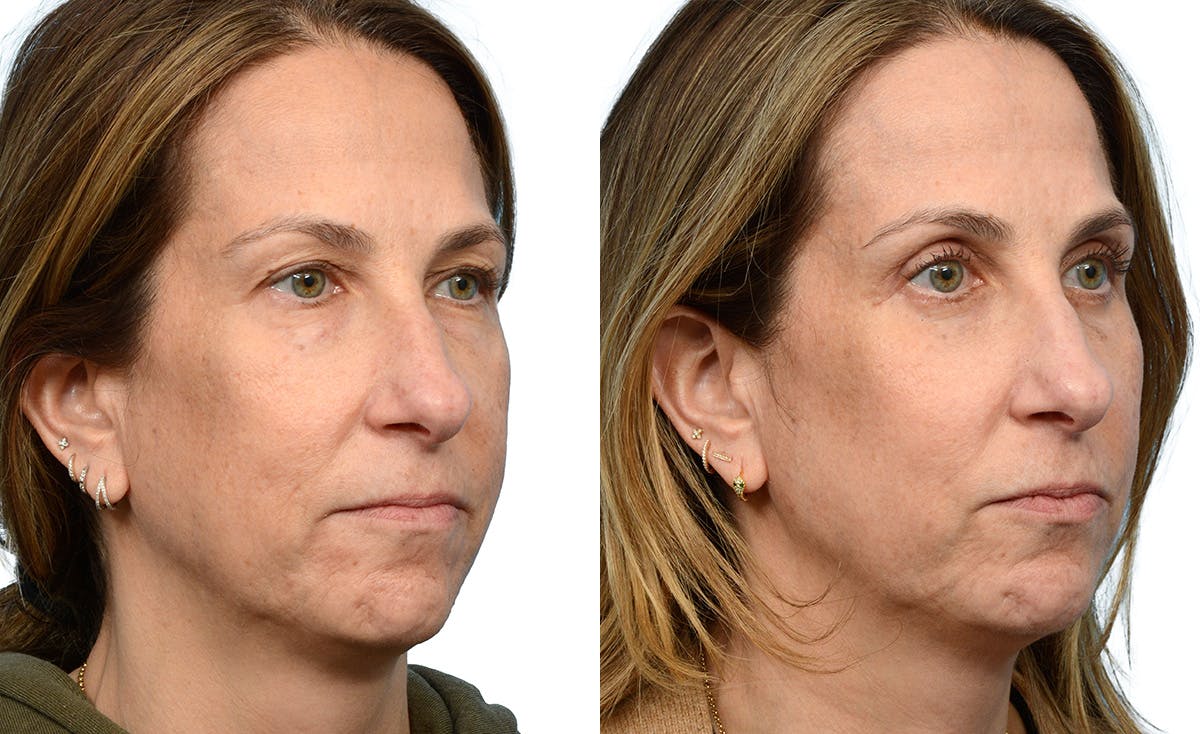 CO2 Laser Before & After Gallery - Patient 164706 - Image 2