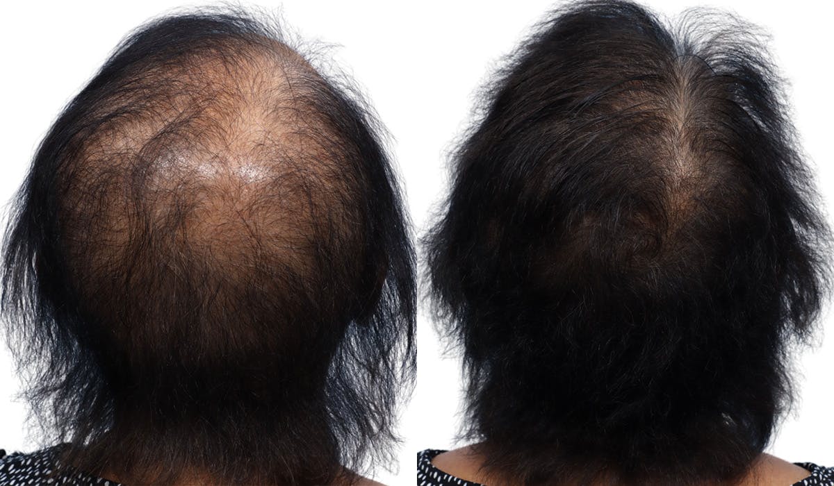 Platelet-Rich-Plasma Before & After Gallery - Patient 822984 - Image 1