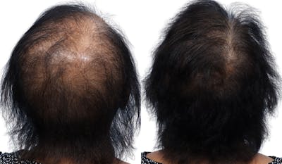Platelet-Rich-Plasma Before & After Gallery - Patient 822984 - Image 1