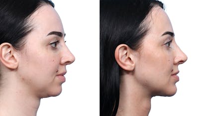 Chin Augmentation Before & After Gallery - Patient 129754 - Image 1