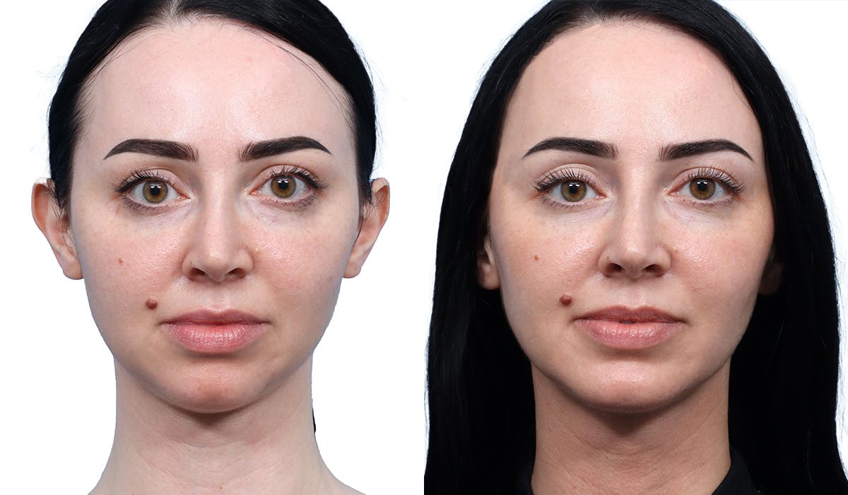 Chin Augmentation Before & After Gallery - Patient 129754 - Image 2