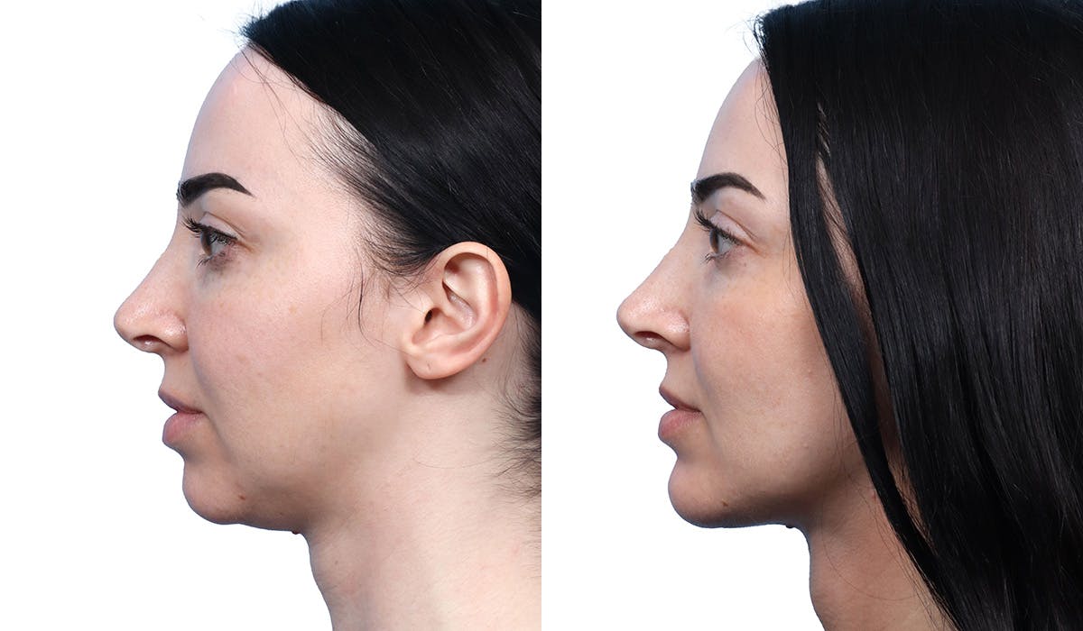Chin Augmentation Before & After Gallery - Patient 129754 - Image 3
