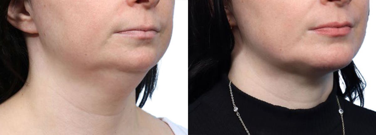Chin Augmentation Before & After Gallery - Patient 271971 - Image 2