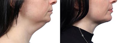 Chin Augmentation Before & After Gallery - Patient 271971 - Image 1
