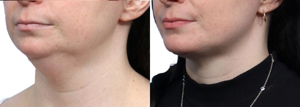 Chin Augmentation Before & After Gallery - Patient 271971 - Image 4
