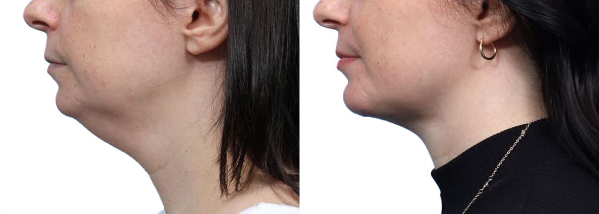 Chin Augmentation Before & After Gallery - Patient 271971 - Image 5