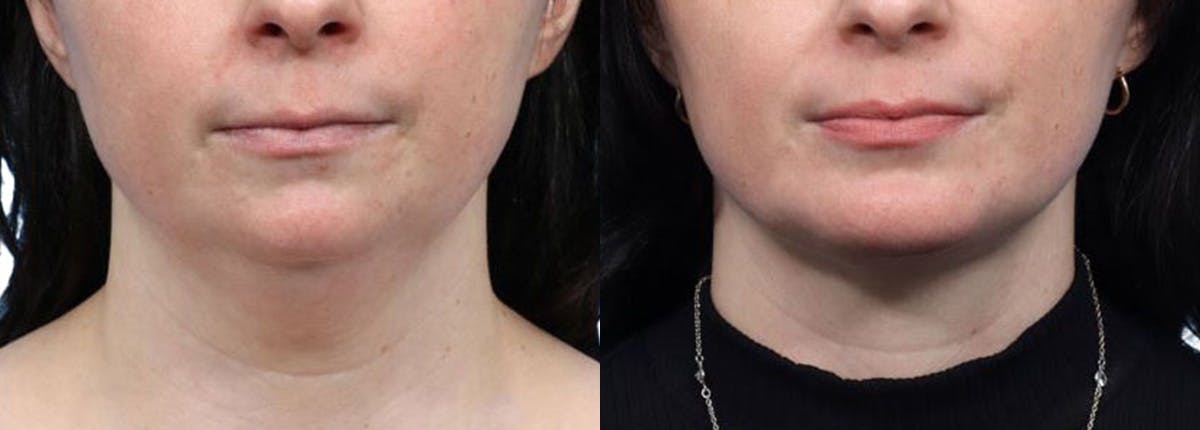 Chin Augmentation Before & After Gallery - Patient 271971 - Image 3