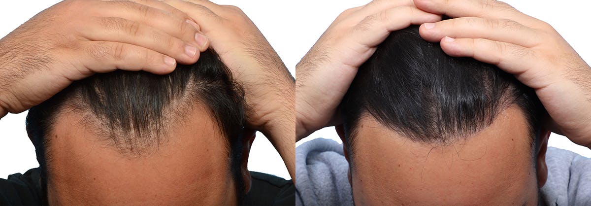 FUE Hair Transplant Before & After Gallery - Patient 418669 - Image 1
