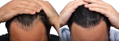 FUE Hair Transplant Before & After Gallery - Patient 418669 - Image 1