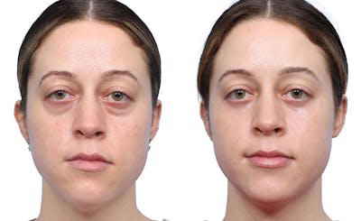 Blepharoplasty (Eyelid Surgery) Before & After Gallery - Patient 234115 - Image 1