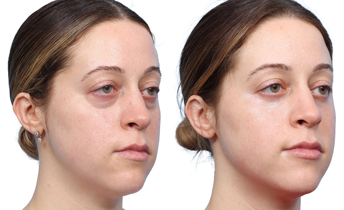 Blepharoplasty (Eyelid Surgery) Before & After Gallery - Patient 234115 - Image 3