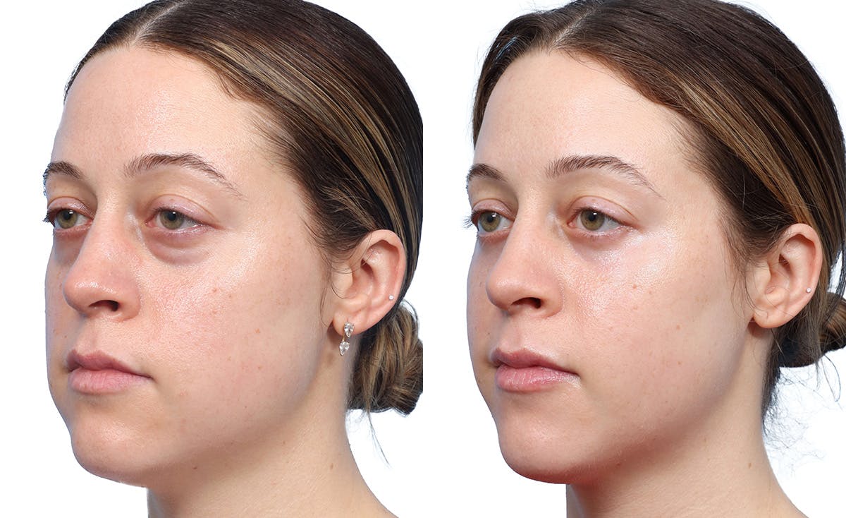 Blepharoplasty (Eyelid Surgery) Before & After Gallery - Patient 234115 - Image 2