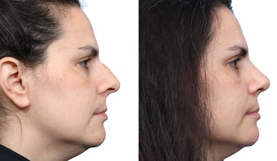 Rhinoplasty Before & After Gallery - Patient 316075 - Image 1